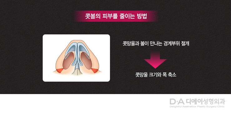 유형별 코성형의 특징과 방법 관련 이미지 20