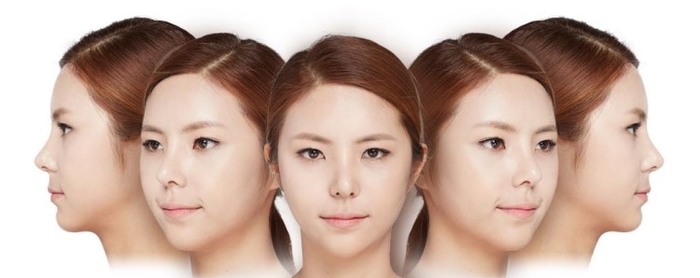 광대 작아지는 방법, 광대재위치술 관련 이미지 5
