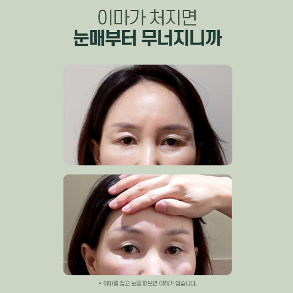 이마주름과 눈처짐을 동시에 개선, 수직 이마거상 관련 이미지 4