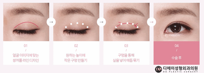 성공적인 눈성형, 관건은 눈형태에 따른 수술법 선택 관련 이미지 7