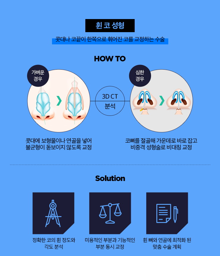 세련된 인상을 만드는 남자 코 성형 BEST 3 관련 이미지 5