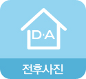 유형별 코성형의 특징과 방법 관련 이미지 29