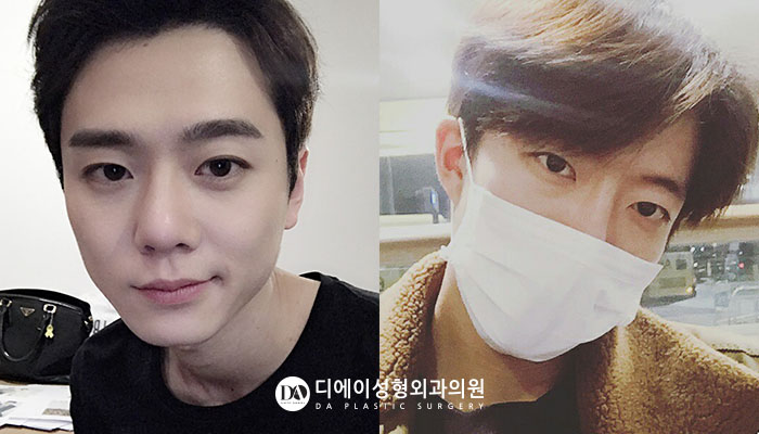 자연스러운 남자성형을 원한다면 관련 이미지 3