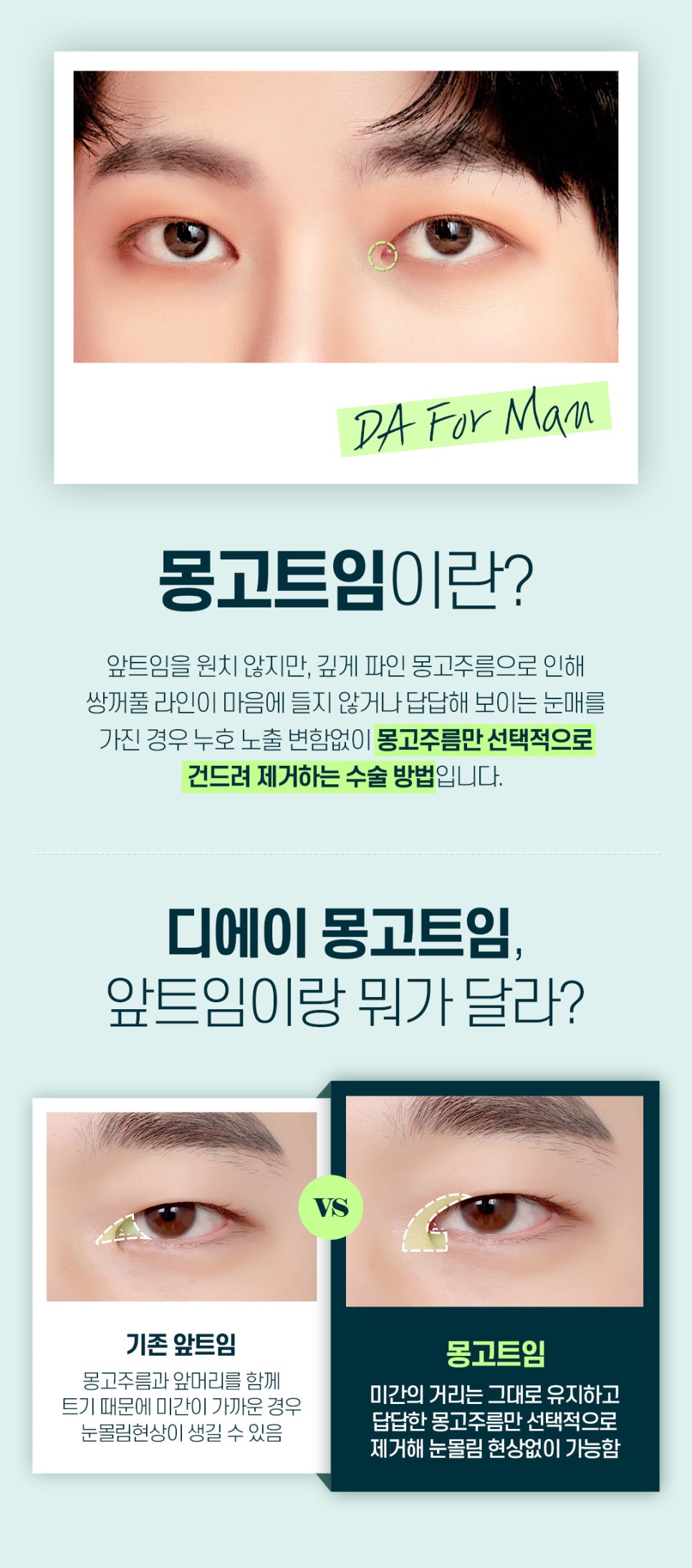 남자앞트임성형 꼼꼼하게 알아보는 법 관련 이미지 5