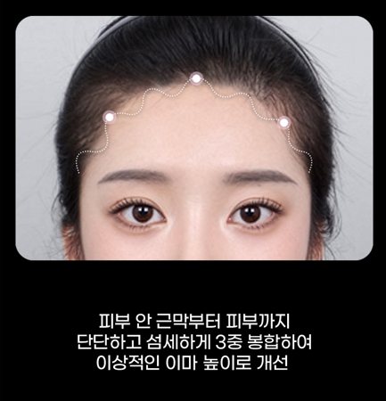 이마축소 수술, 헤어라인만으로 달라지는 얼굴 비율 관련 이미지 5