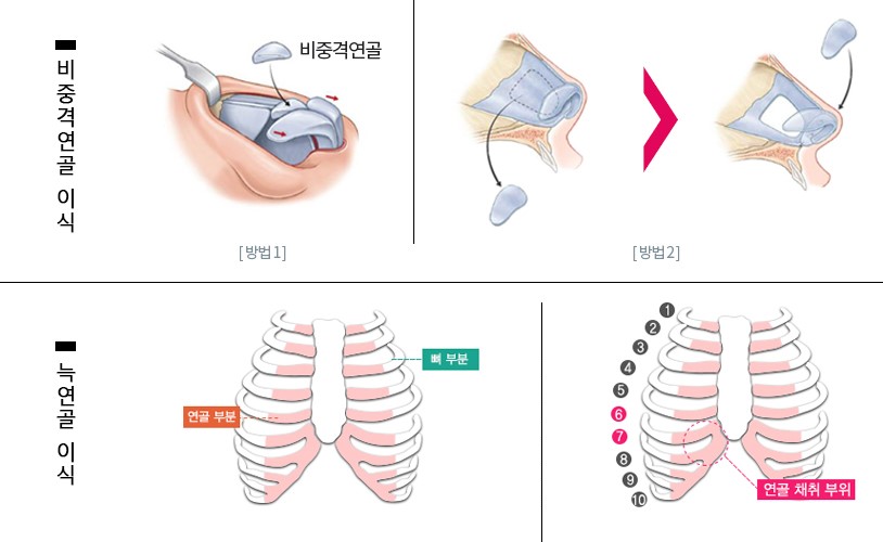 이상적인 코성형, 그 방법은? 관련 이미지 13