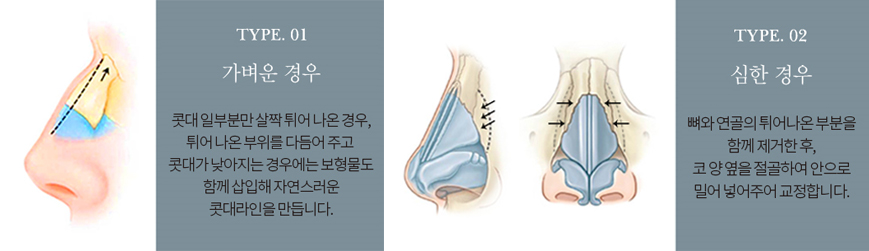 이상적인 코성형, 그 방법은? 관련 이미지 8