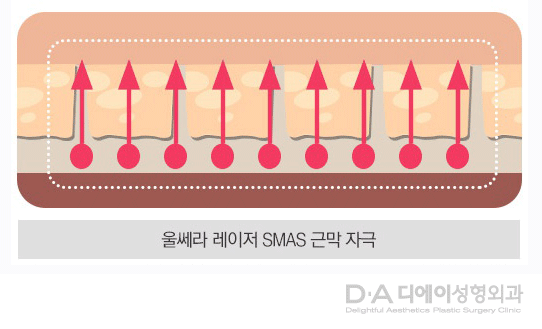 V라인을 위한 리프팅 종류 알아보기 관련 이미지 5