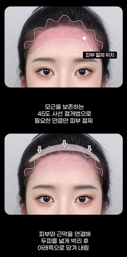 이마축소 수술, 헤어라인만으로 달라지는 얼굴 비율 관련 이미지 4