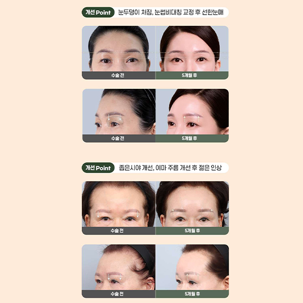 이마주름과 눈처짐을 동시에 개선, 수직 이마거상 관련 이미지 13