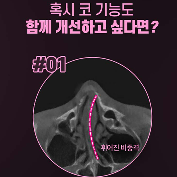 What Matters More Than a Nasal Ala Reduction Review image 8