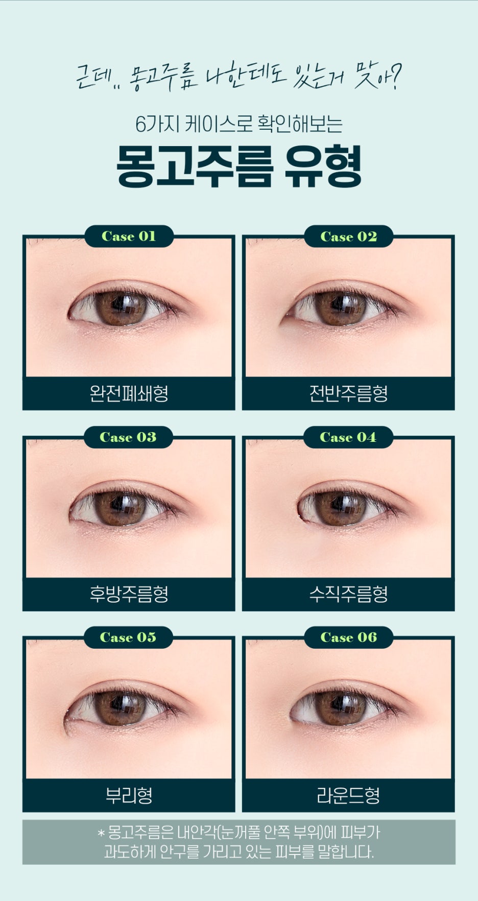 남자앞트임성형 꼼꼼하게 알아보는 법 관련 이미지 4
