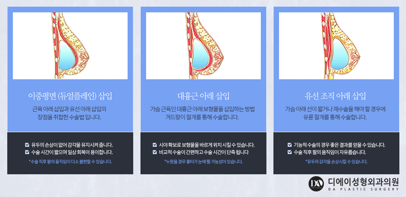 실패없는 가슴재수술 A~Z 관련 이미지 8