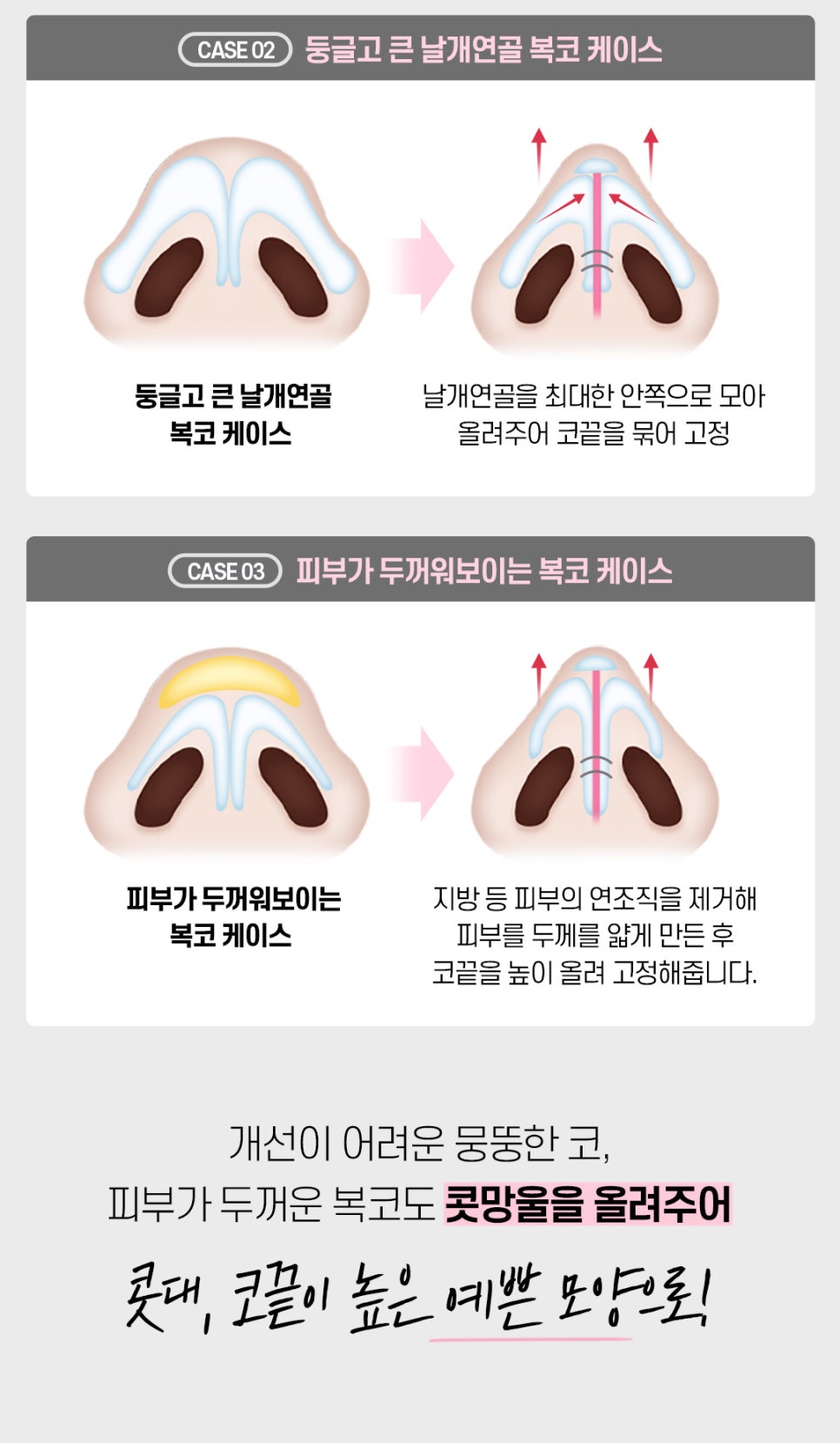 마지막 코재수술 원한다면♡ [DA성형외과] 관련 이미지 7