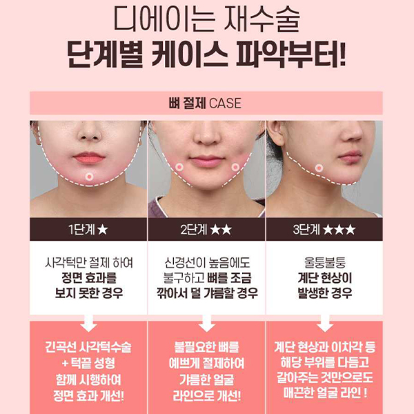 Not Satisfied After Your First Surgery? A Guide to Revision Facial Contouring Surgery image 4