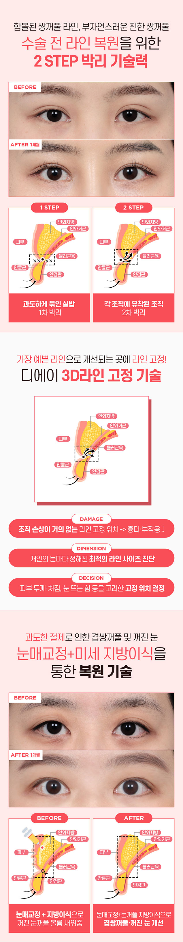 강남역 눈재수술 잘 하는 곳 관련 이미지 5