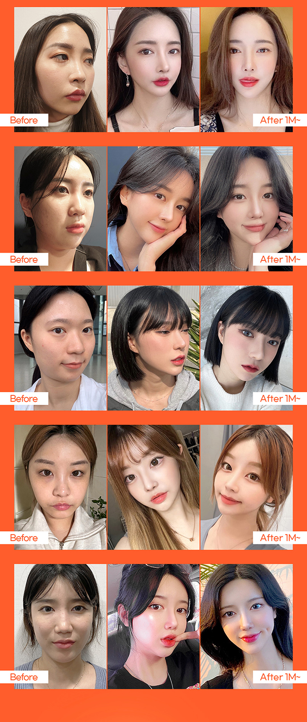 오래도록 오똑하게 자가늑코성형 관련 이미지 6