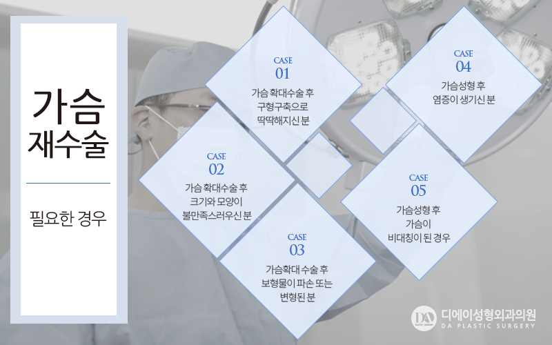 실패없는 가슴재수술 A~Z 관련 이미지 3