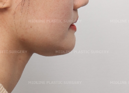 Fixing a Sagging Double Chin After Contouring Surgery! Let’s Learn About Mid-Up Lifting 2040. image 2