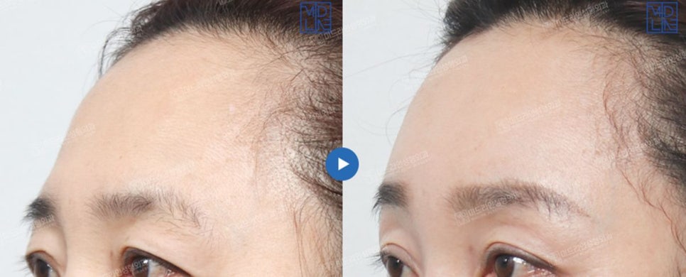 Endoscopic forehead lift that removes wrinkles and creates natural forehead volume! image 14