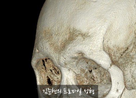 Let’s Learn About the Effects of Brow Bone Reduction Surgery. (Brow Bone? Eye Hole Bone? Here’s a Terminology Guide.) image 8