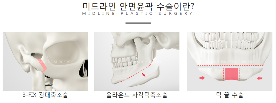 Fixing Sagging After Facial Contouring Surgery with a Face Lift!! (Feat. Plate Removal, Plate & Screw Removal) image 1