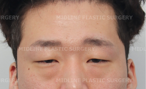 <2편> 쌍꺼풀 수술 없이 눈을 크게 만드는 방법을 성형외과 전문의가 직접 설명드립니다. 관련 이미지 7