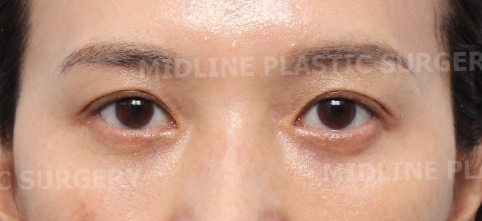 눈두덩이 꺼짐을 해결할 수 있는 눈꺼풀 지방이식! 성형외과 전문의가 설명드립니다. 관련 이미지 16