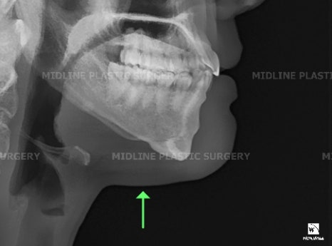 Fixing a Sagging Double Chin After Contouring Surgery! Let’s Learn About Mid-Up Lifting 2040. image 8