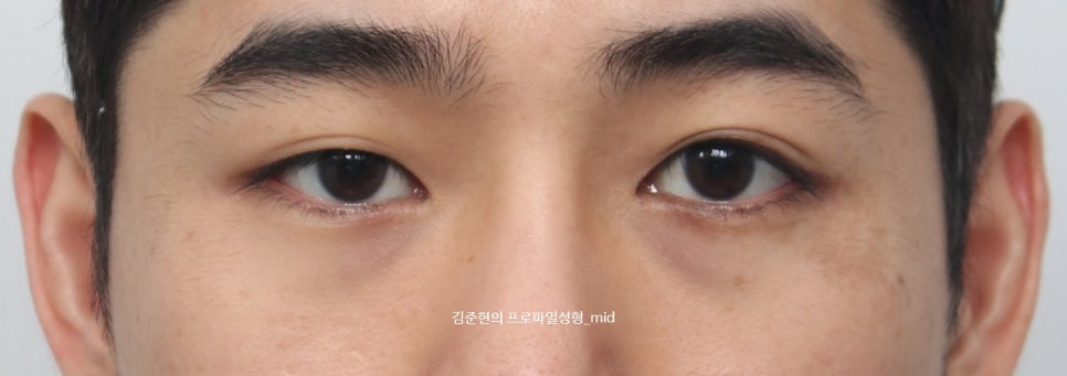 미드라인성형외과 김준현원장이 알려주는 눈밑지방재배치와 눈밑지방이식. 관련 이미지 3