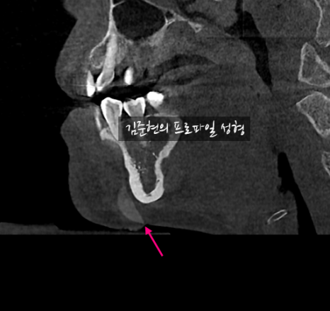 앞턱 보형물이 턱 아래로 뚫고 나와요..ㅠㅠ 앞턱 보형물 제거 후 턱끝 전진술한 경우를 성형외과 전문의가 설명드립니다. 관련 이미지 3