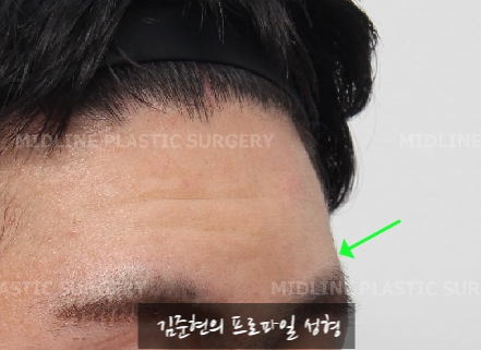 Let’s Learn About the Effects of Brow Bone Reduction Surgery. (Brow Bone? Eye Hole Bone? Here’s a Terminology Guide.) image 22