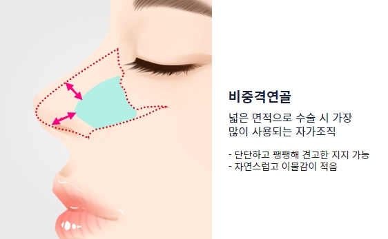 휜 코, 매부리 교정과 기능코-비중격만곡증까지 바로잡기 관련 이미지 16