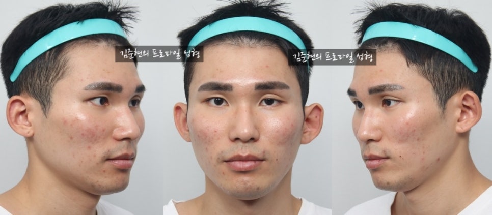 45도 광대와 옆광대를 모두 줄이는 광대축소술을 성형외과 전문의가 알려드립니다. 관련 이미지 5