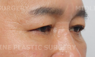 나이 들어 보이는 눈밑! 하안검으로 개선 가능한 부분들을 성형외과 전문의가 직접 알려드립니다. 관련 이미지 13