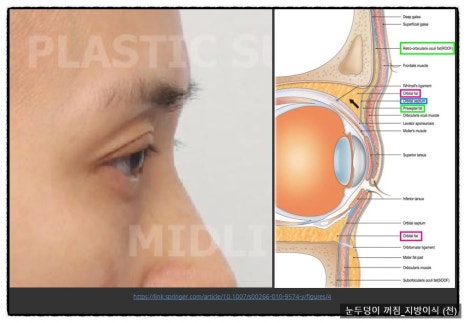 Sallow Eyes, Sunken Eyes Solved with Fat Grafting! (Feat. Dark Circles) image 3