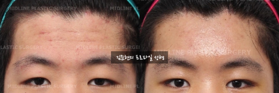 How Can Deep Forehead Wrinkles Be Resolved? (Feat. Forehead Lift + Filler) image 11