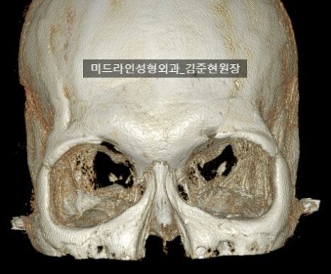 눈썹뼈 절삭에 관하여 (안와상융기) 관련 이미지 1