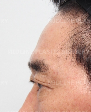 Endoscopic forehead lift that removes wrinkles and creates natural forehead volume! image 3