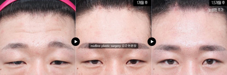 Headache, vomiting, pain, nausea after forehead lift... is it a side effect?! Here's my answer. image 5