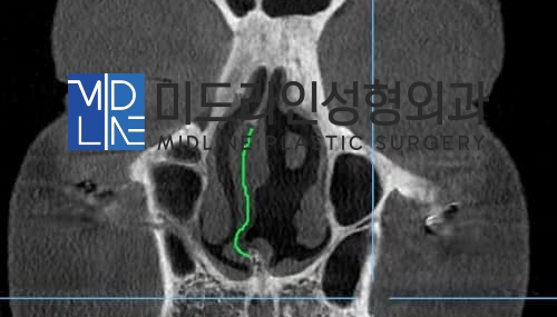 The Plastic Surgery Specialist Explains Septoplasty, One of the Methods for Functional Nose Surgery for Rhinitis. (feat. Swing-door Technique) image 1