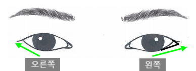 What Type of Plastic Surgery Is Needed for Small, Cramped Eyes? (About Lateral, Lower, and Combined Lateral-Lower Canthoplasty) image 7