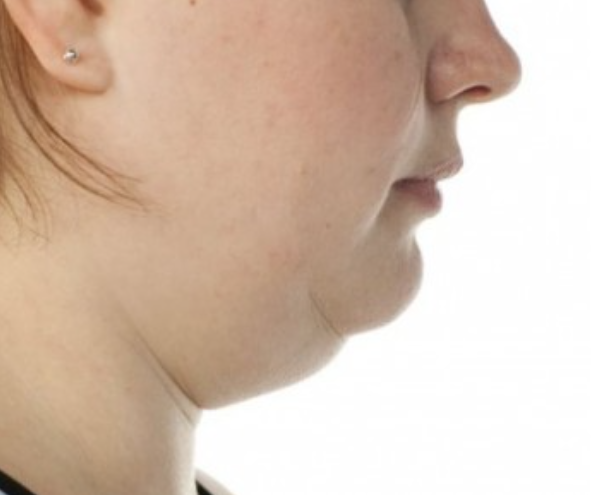 On the Effects of Advancement Genioplasty, Explained by a Board-Certified Plastic Surgeon. (feat. Rhinoplasty, Double Chin, Jawline Liposuction) image 1