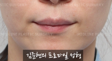 입술에 볼륨을 주는 방법은? 입술 지방이식에 관하여 관련 이미지 3