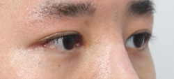 What Type of Plastic Surgery Is Needed for Small, Cramped Eyes? (About Lateral, Lower, and Combined Lateral-Lower Canthoplasty) image 14