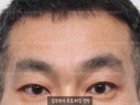 쌍꺼풀을 하려는데 이마주름이 심각해요....어떡하죠? 상남자의 자연스런 쌍꺼풀 만들기(Feat. 내시경 이마거상) 관련 이미지 8