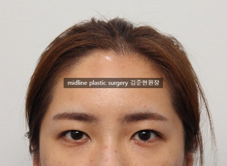 Forehead lift for people in their 20s and 30s: correcting eyelid sagging and even eye asymmetry! image 11