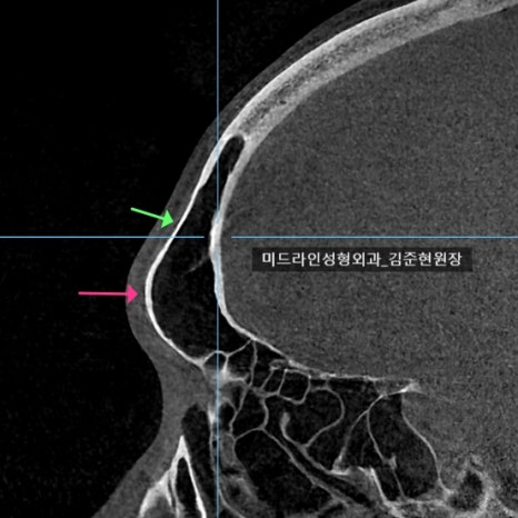 눈썹뼈 절삭에 관하여 (안와상융기) 관련 이미지 13