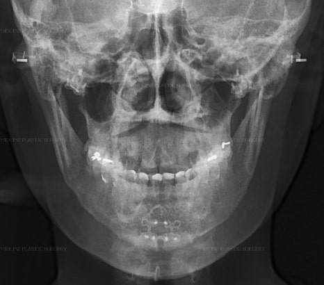 Fixing Sagging After Facial Contouring Surgery with a Face Lift!! (Feat. Plate Removal, Plate & Screw Removal) image 5