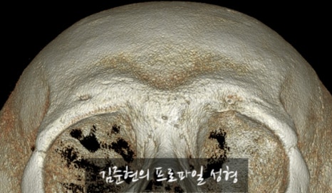Let’s Learn About the Effects of Brow Bone Reduction Surgery. (Brow Bone? Eye Hole Bone? Here’s a Terminology Guide.) image 12